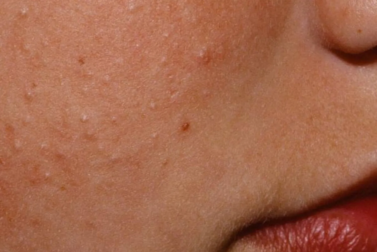 Bumpy Skin and Nutrition Bumpy Skin and Nutrition