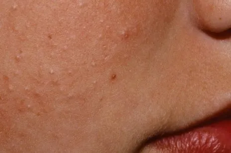 Bumpy Skin and Nutrition