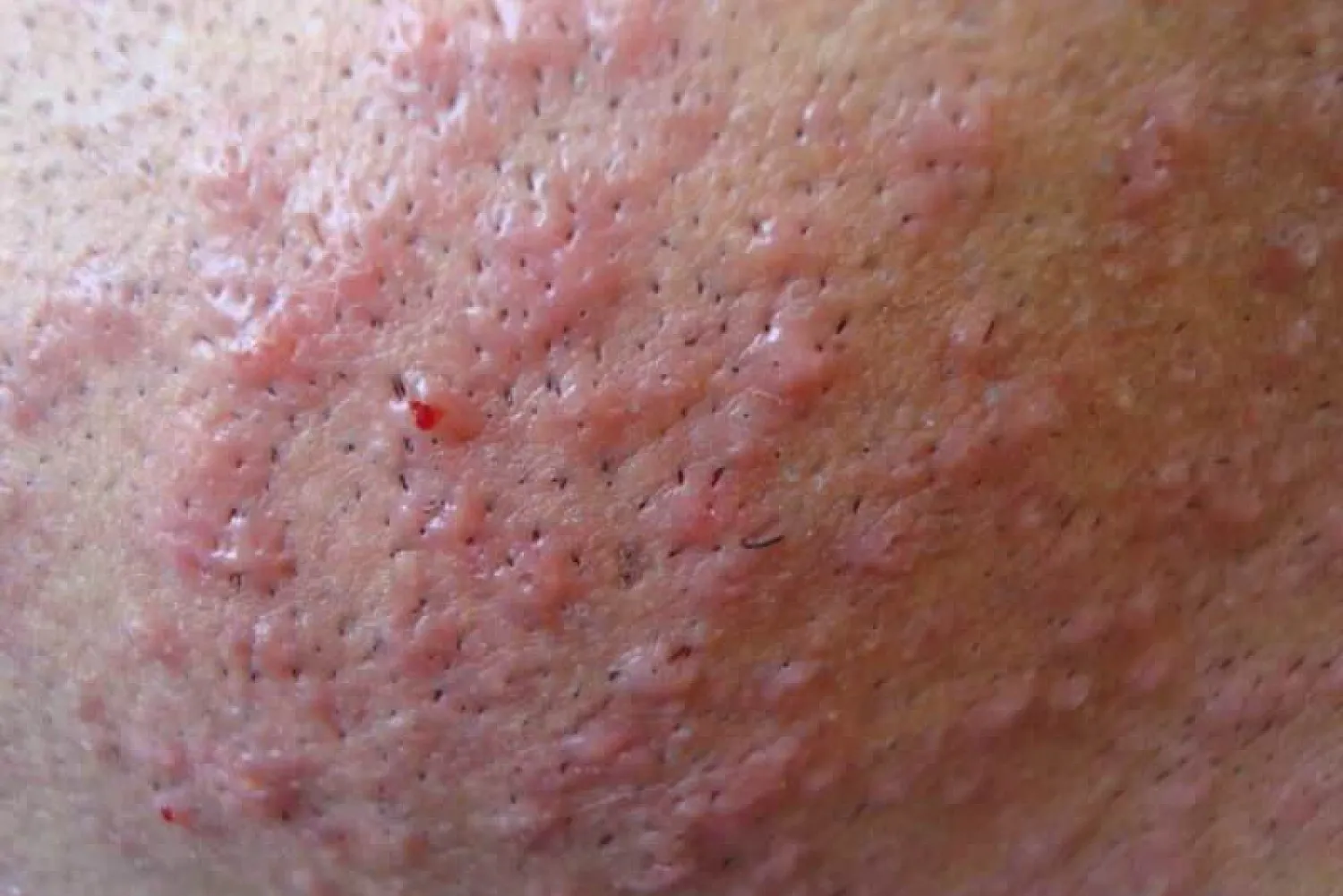 Razor Burn Tips Razor Burn Tips