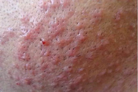 Razor Burn Tips