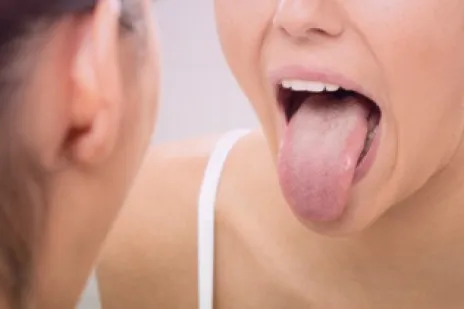 How to Treat Oral thrush
