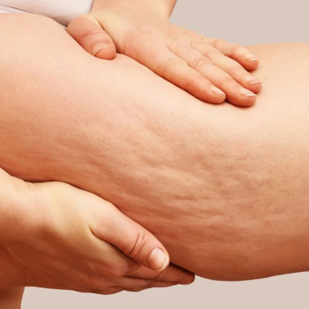 Cellulite Removal