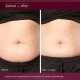 Stomach before & after with Dermalogica Dynamic Skin Sculptor Stomach before & after with Dermalogica Dynamic Skin Sculptor