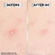 Garnier Invisible Pimple Patch 22 Pack Garnier Invisible Pimple Patch 22 Pack