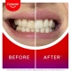 Colgate Max White Ultimate At Home Led Teeth Whitening Kit Colgate Max White Ultimate At Home Led Teeth Whitening Kit